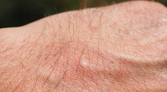 Odczulanie Odczulanie